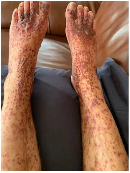 Figura 1: Lesões cutâneas na apresentação do quadro.
